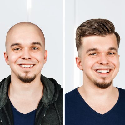 Man,Before,And,After,Transplant,Hair,And,Alopecia.