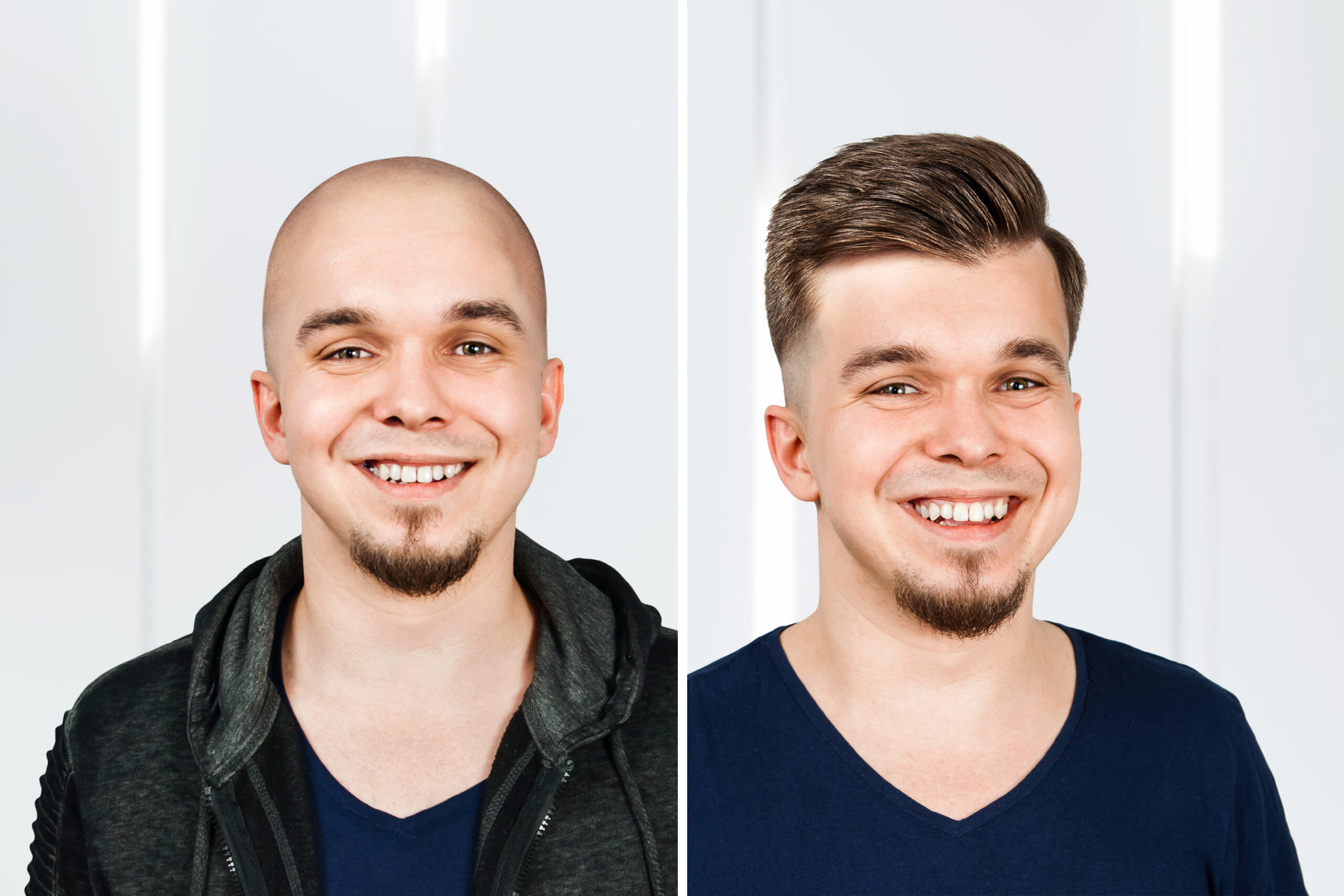 Man,Before,And,After,Transplant,Hair,And,Alopecia.